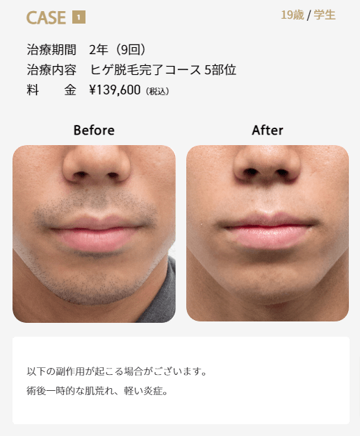 ゴリラクリニックのヒゲ脱毛症例画像