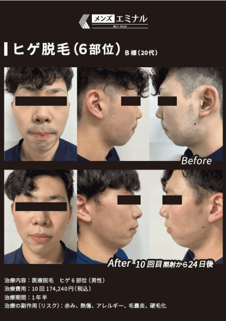 メンズエミナルクリニックでヒゲ脱毛の施術を受けた方の症例画像