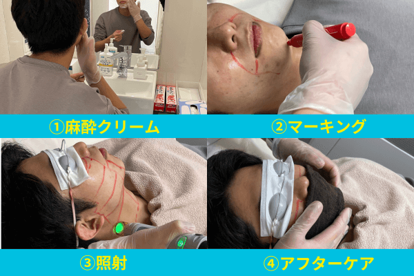 メンズリゼクリニックで実際にヒゲ脱毛を受けた画像