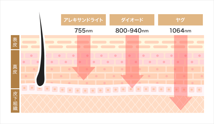 3種類のレーザー脱毛の波長を比べる画像