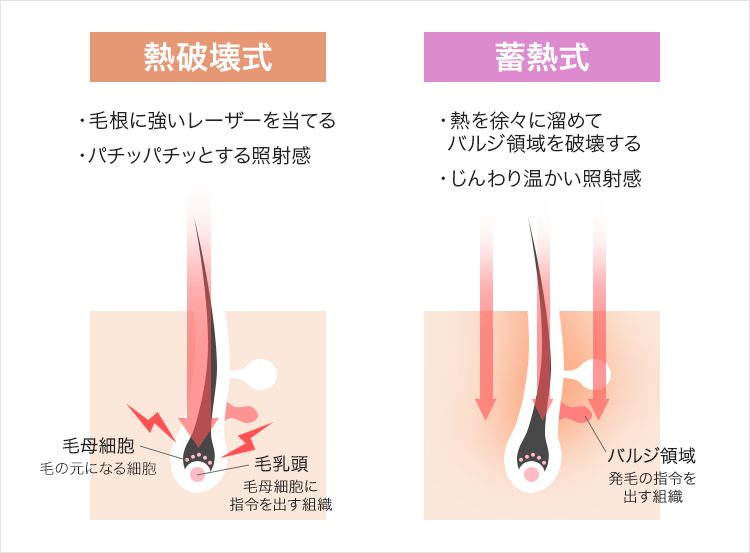 レーザー脱毛の熱破壊式と蓄熱式の比較画像