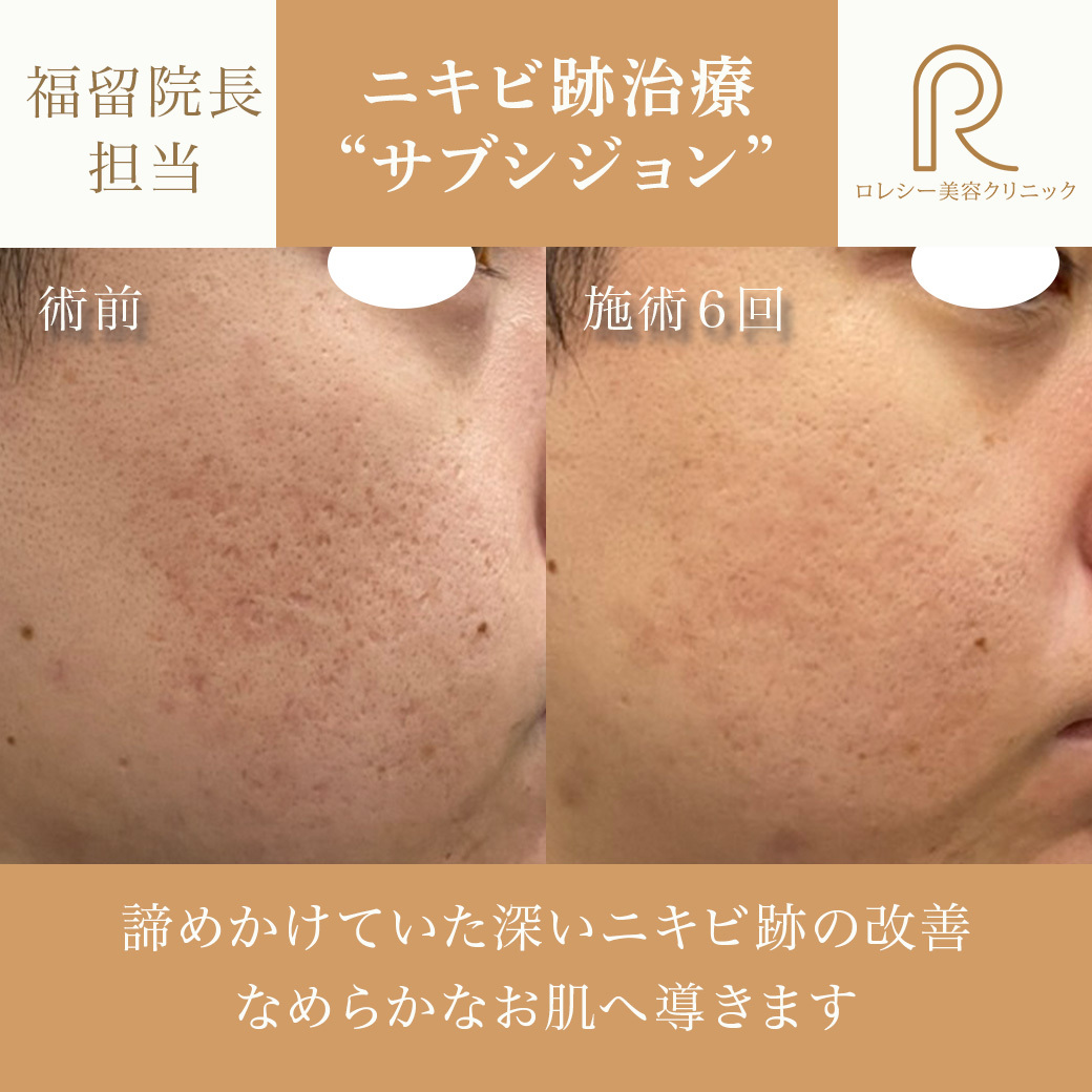 サブシジョン症例写真