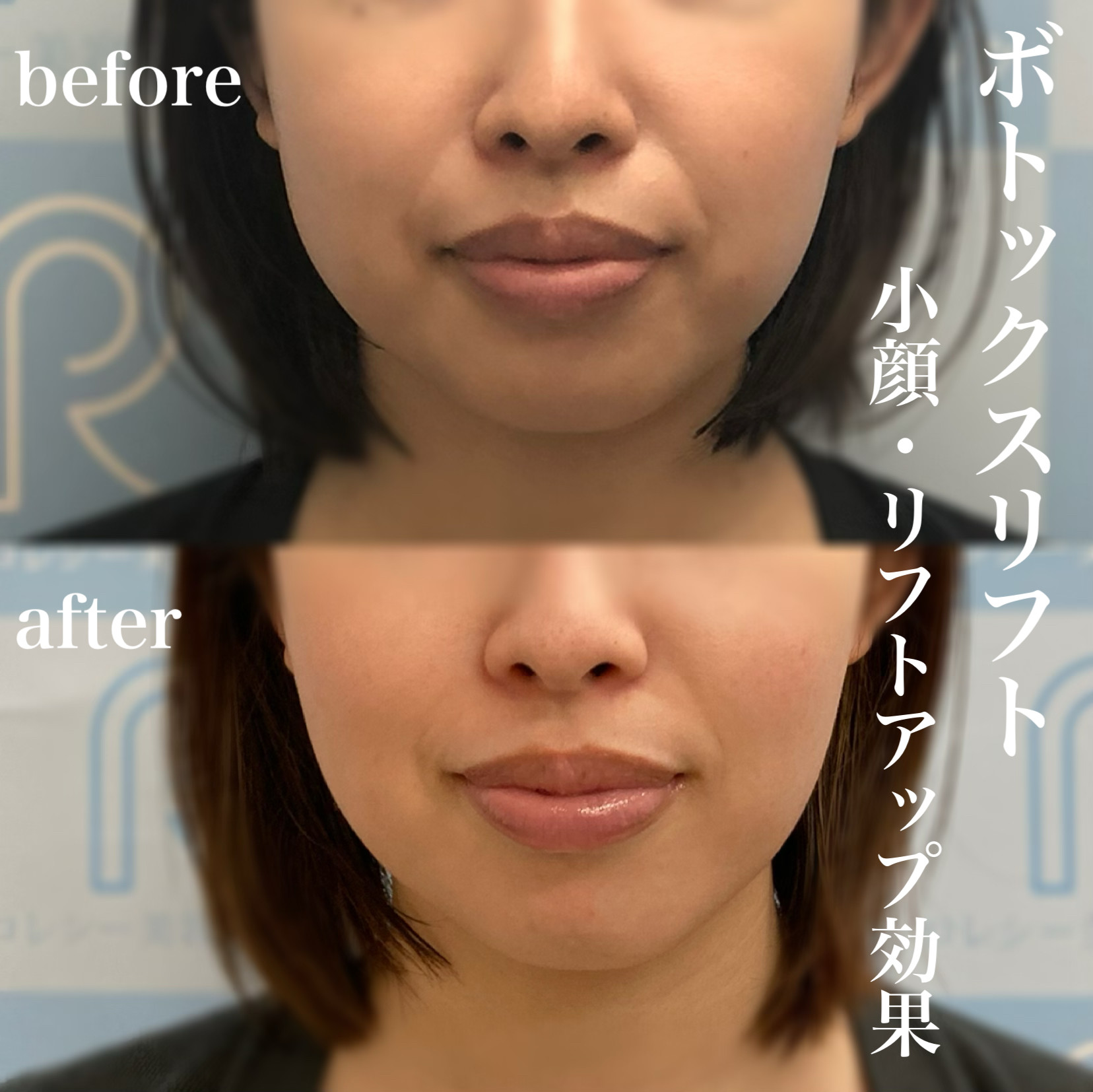 小顔ボトックス症例写真