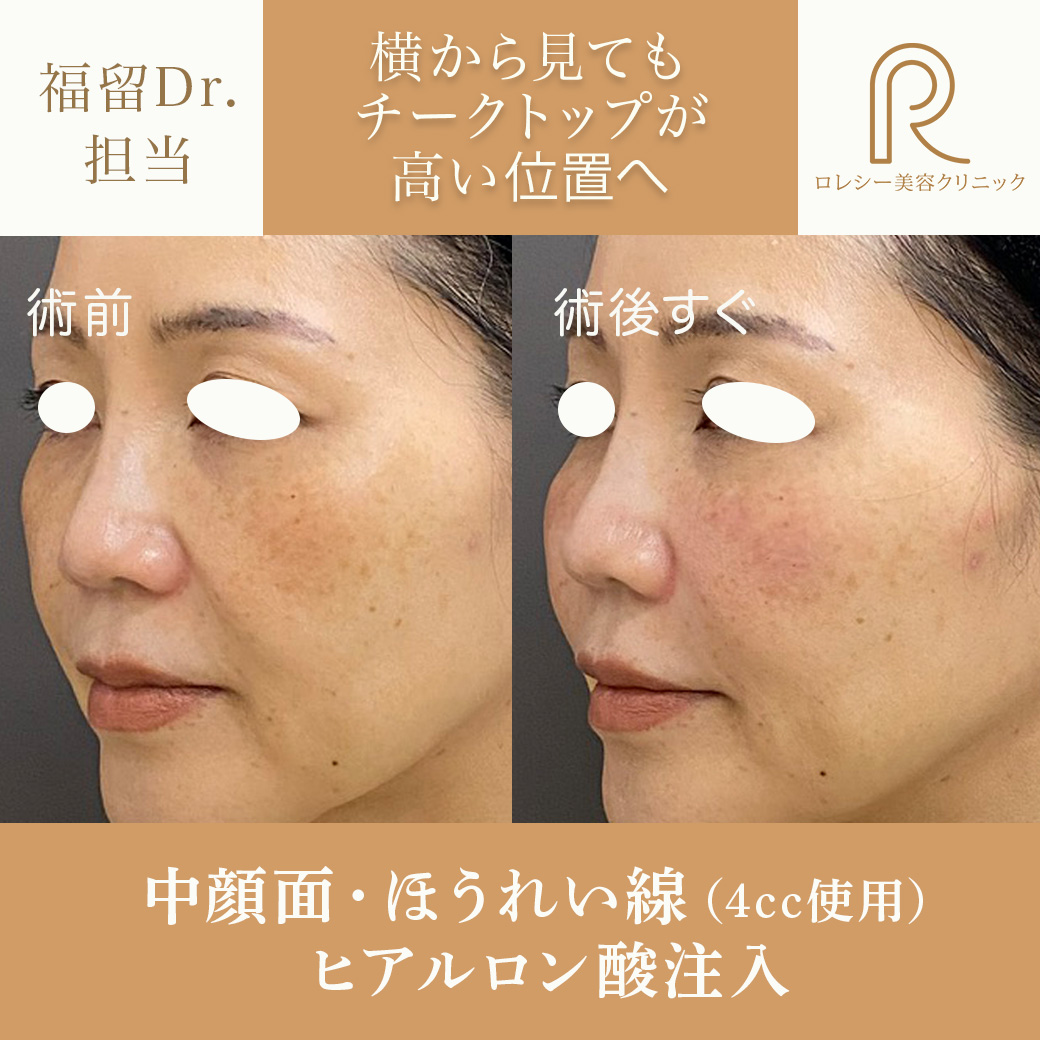 しわたるみほうれい線改善ヒアルロン酸注入症例写真