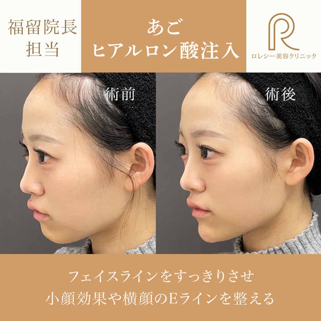 顎ヒアルロン酸注入症例写真