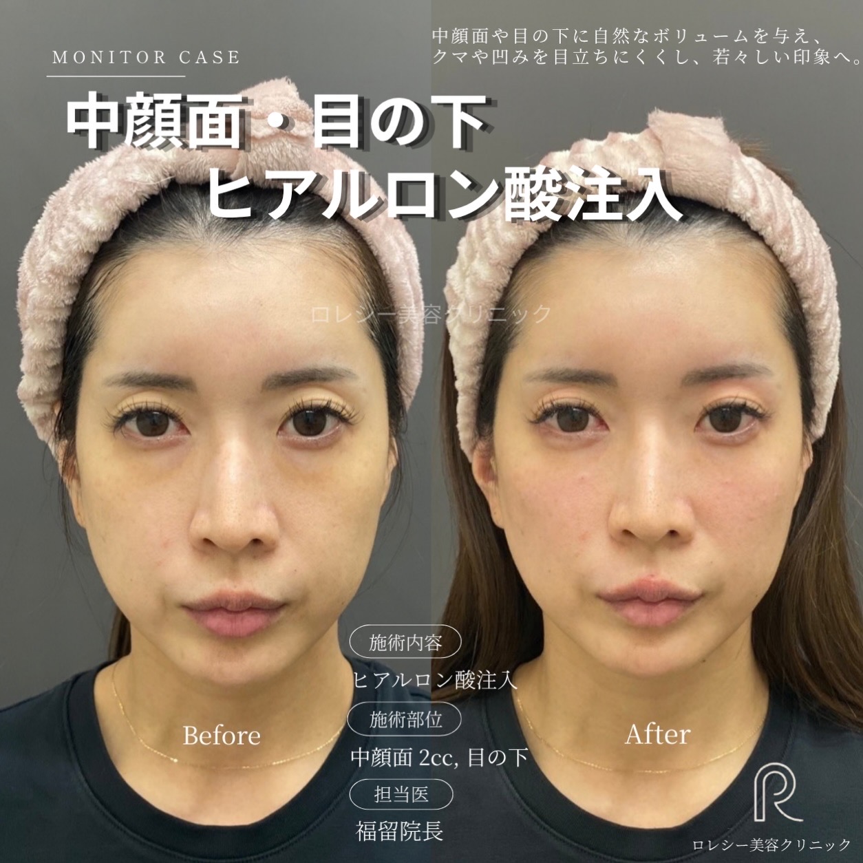 しわたるみほうれい線改善ヒアルロン酸注入症例写真