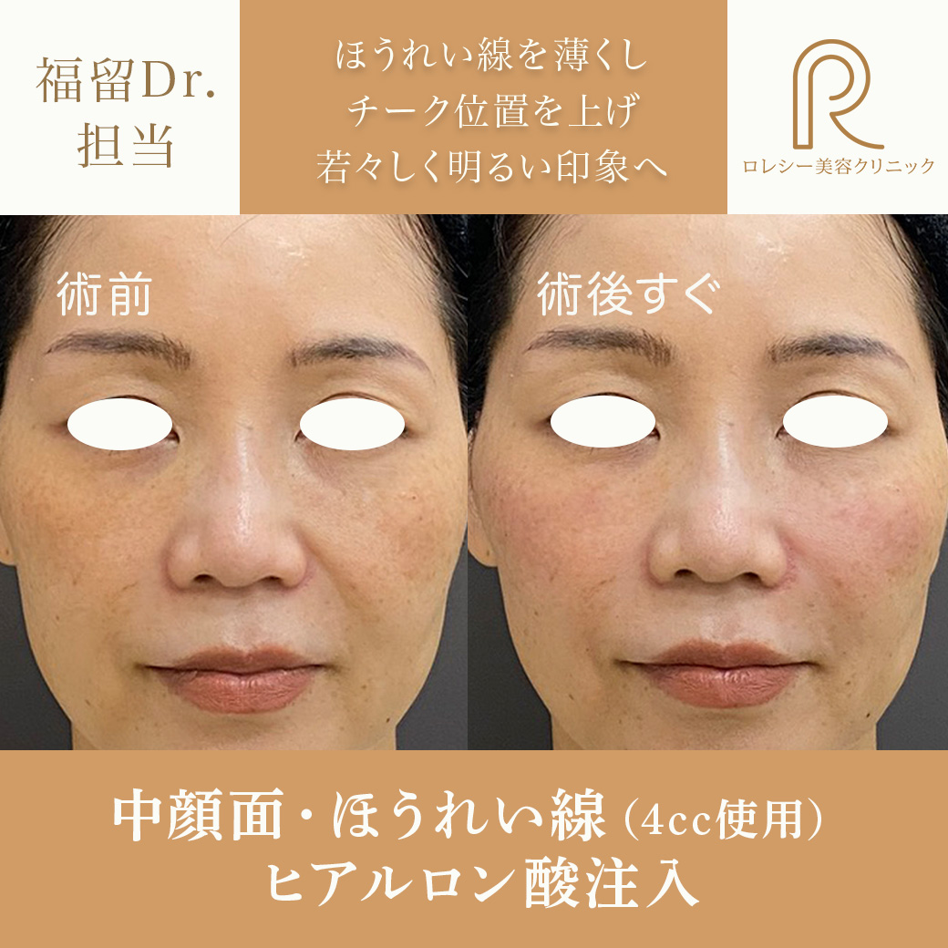 しわたるみほうれい線改善ヒアルロン酸注入症例写真