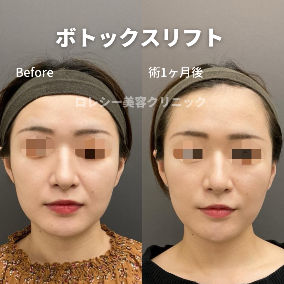 小顔ボトックス症例写真