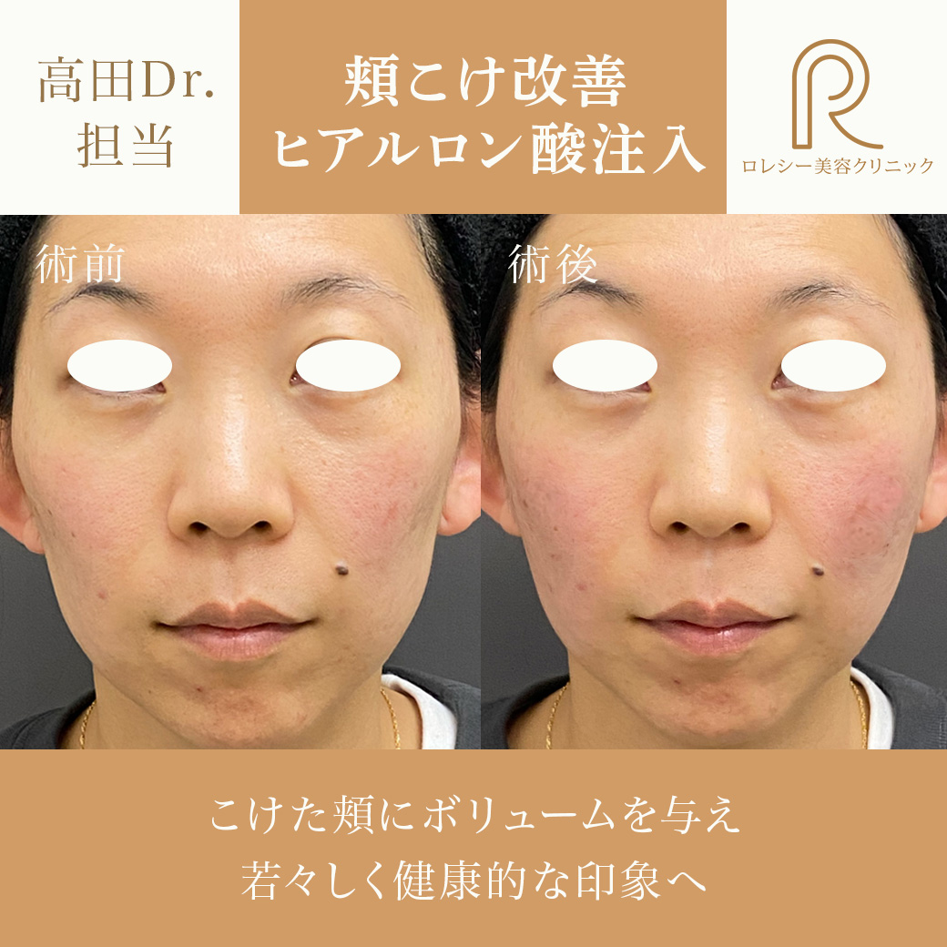 頬コケヒアルロン酸注入症例写真