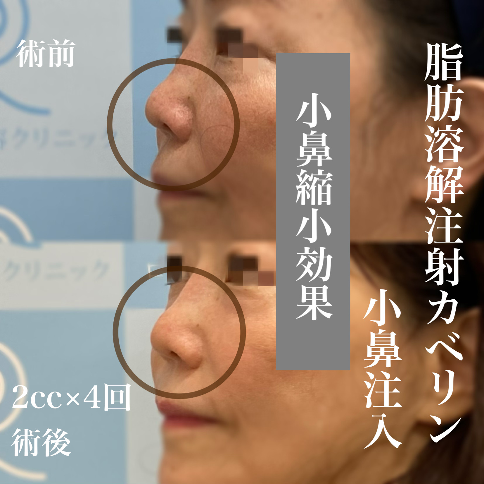 カベリン両小鼻注入 2cc4回施術の症例写真