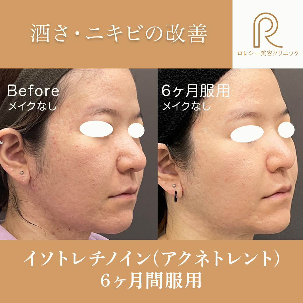 イソトレチノイン(アクネトレント)症例写真