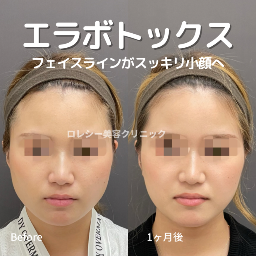 小顔ボトックス症例写真
