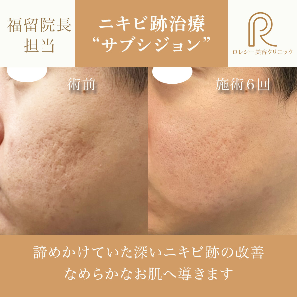 サブシジョン症例写真