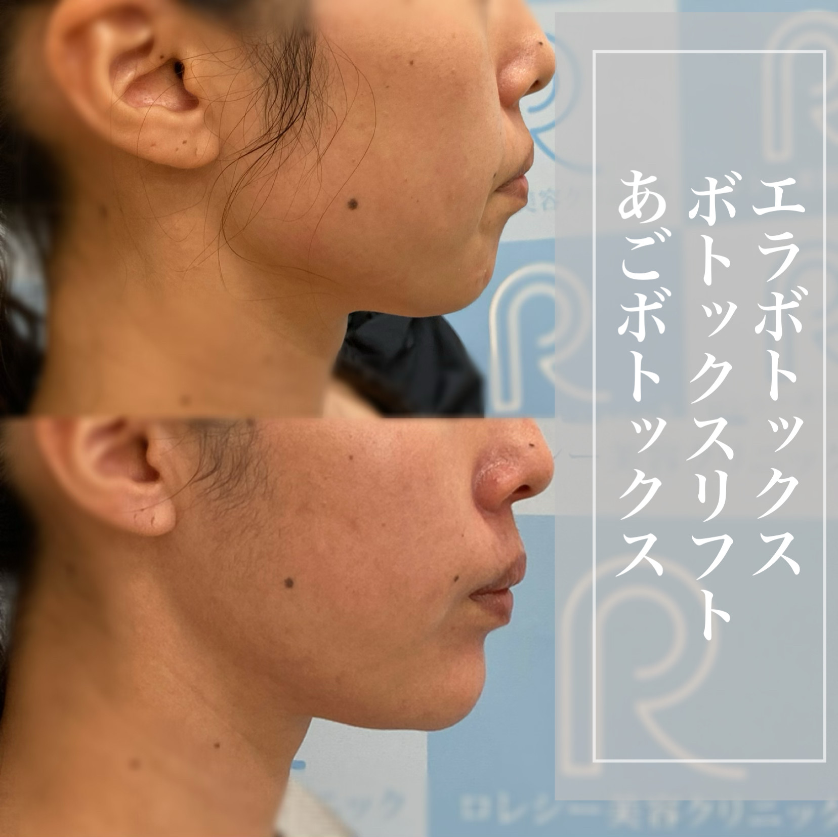 小顔ボトックス症例写真