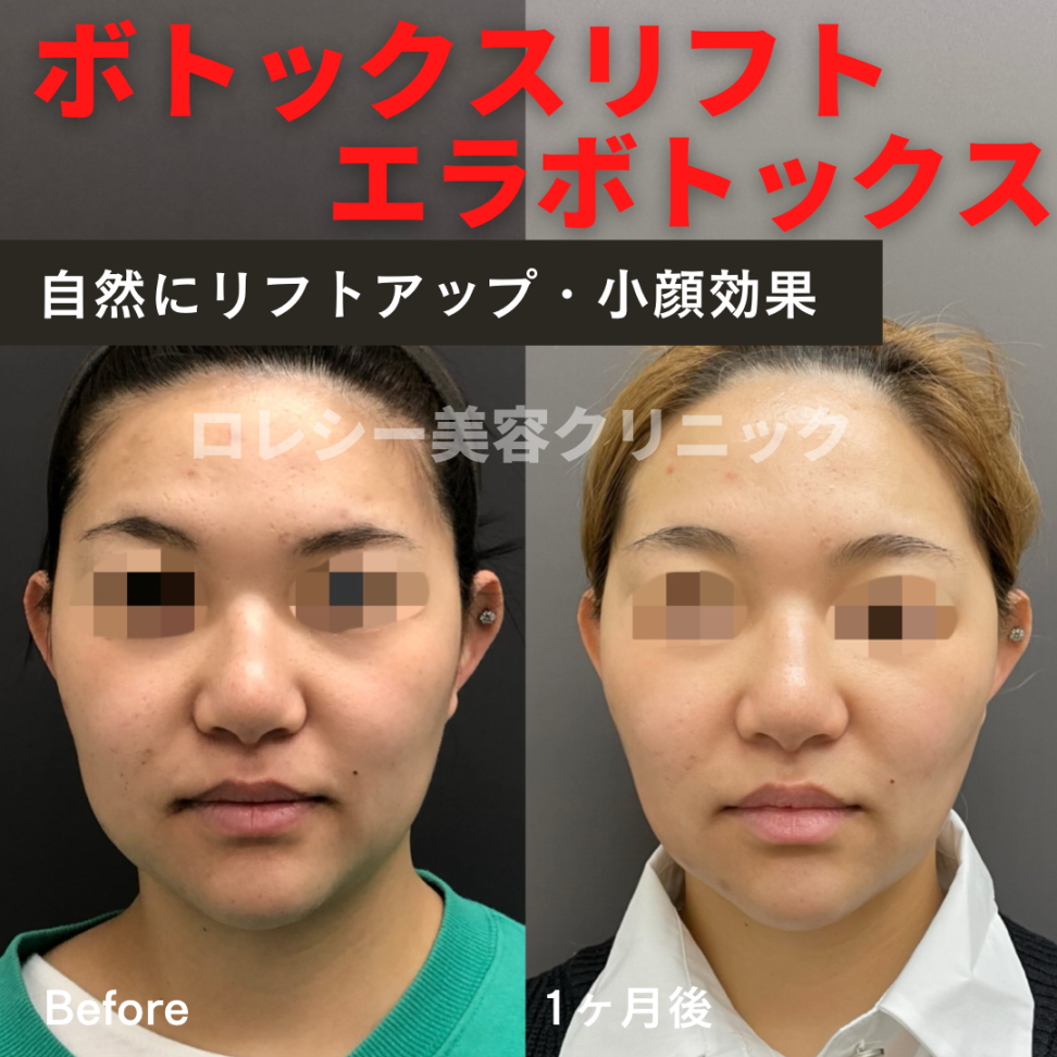 小顔ボトックス症例写真