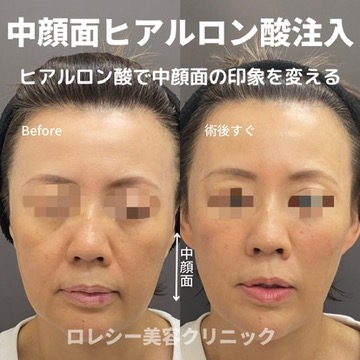 中顔面ヒアルロン注入症例写真