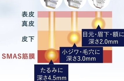 HIFUとは?